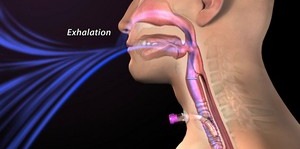 Exhalation with the Passy Muir Speaking Valve